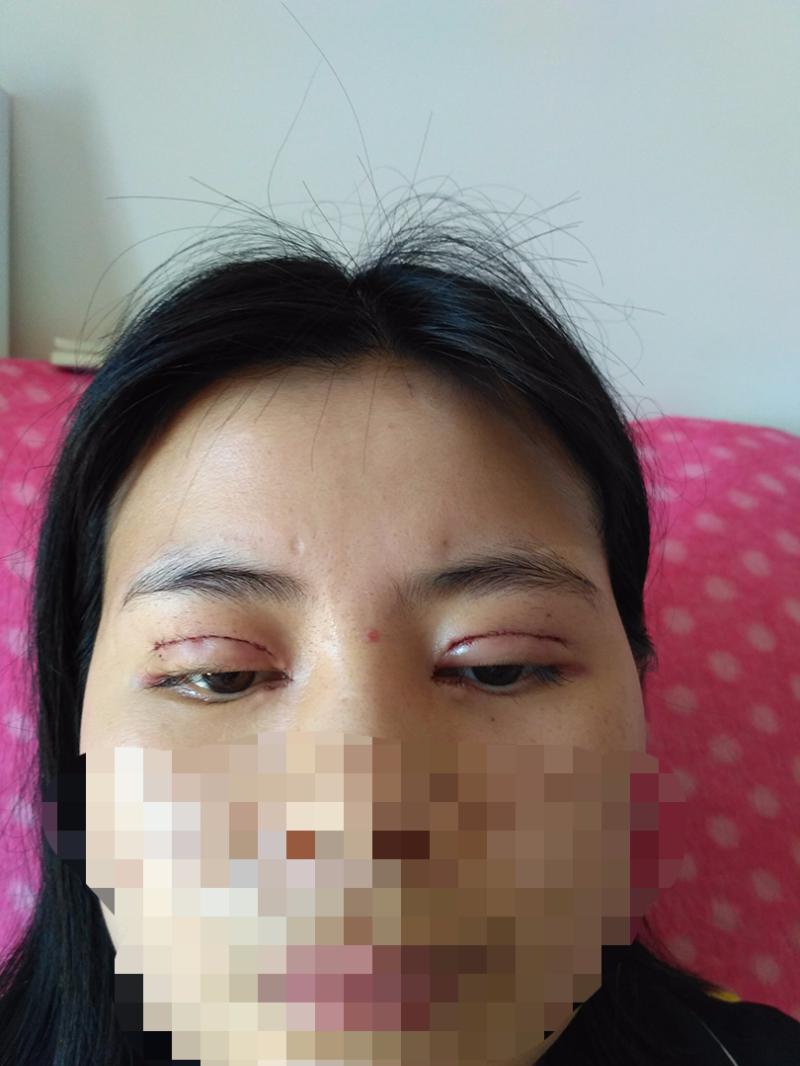 华美紫馨做双眼皮失败