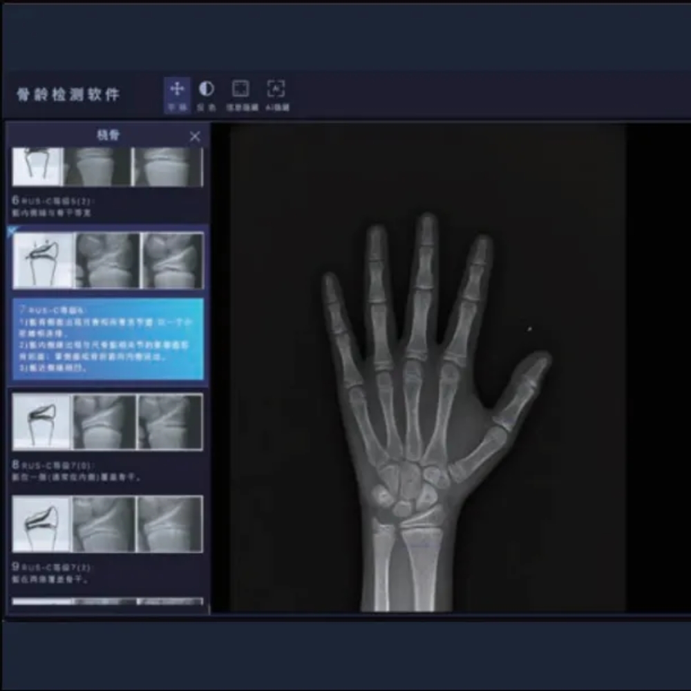 安智龄 AI赋能判读 骨龄测定软件 AZK_Bone_Age