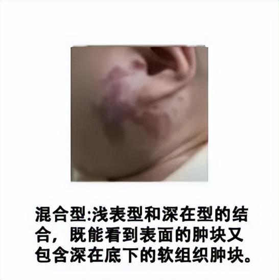 胎记的位置与命运(婴儿血管瘤一般在什么时候出现？)