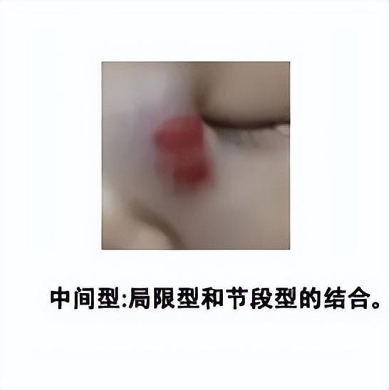 胎记的位置与命运(婴儿血管瘤一般在什么时候出现？)