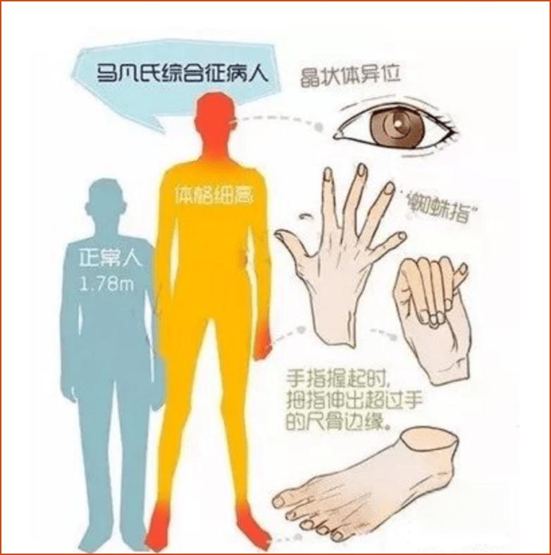 马凡氏综合征的确诊和治疗 马凡氏综合征(down syndrome)是一种由于