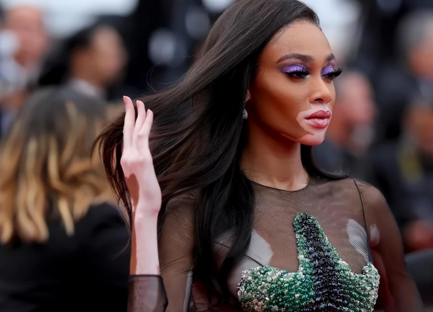 温妮·哈洛:从白癜风困扰到世界顶级超模的坚韧之旅 温妮·哈洛,一个