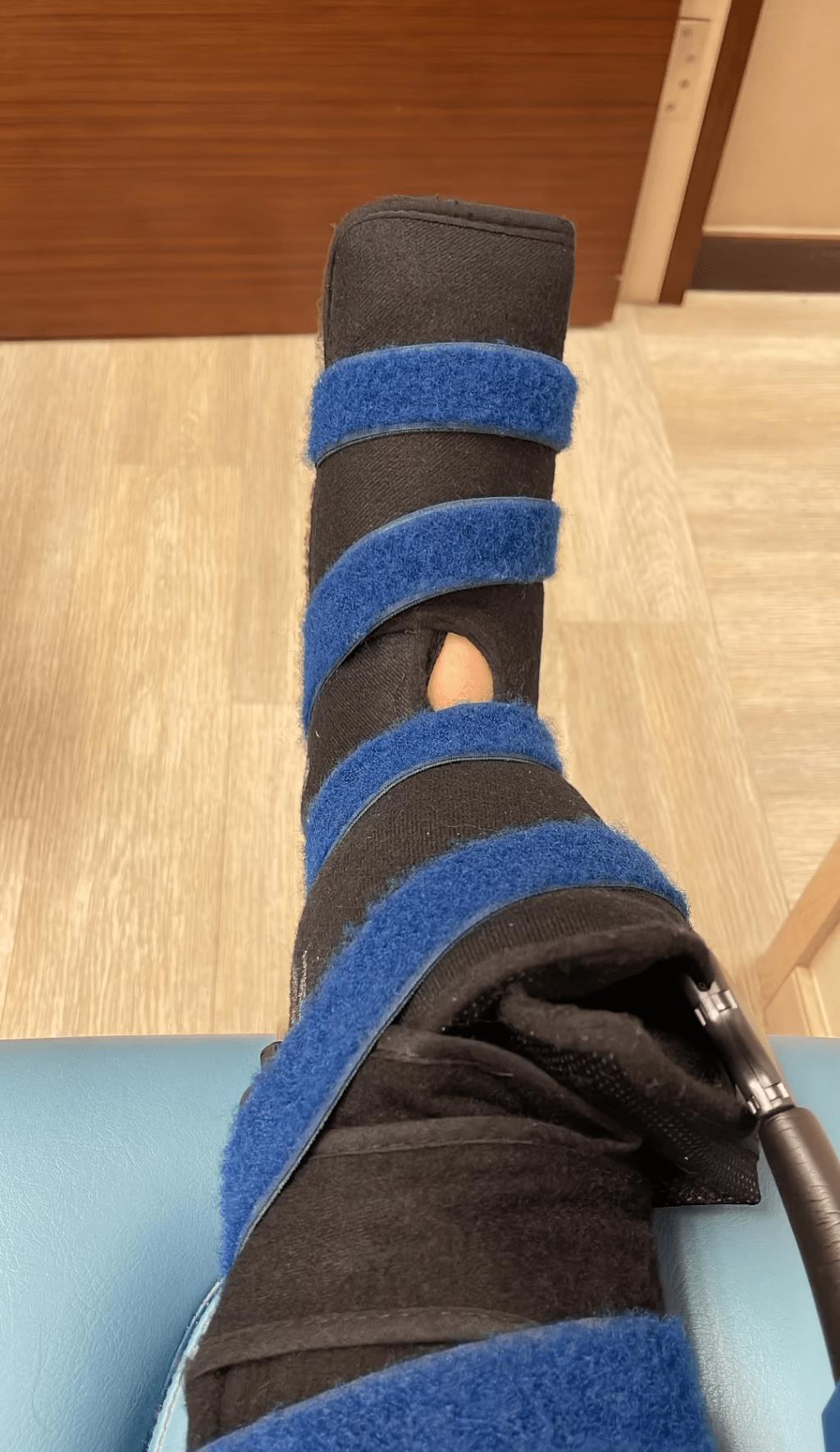 tvb女星谭凯琪脚扭伤需拄拐,脚肿如猪蹄 现年42岁的tvb女星谭凯琪,在