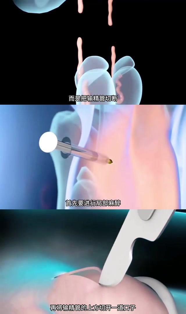 避孕与生育的博弈 男性结扎手术是一种绝育手段,通过切断输精管来阻止