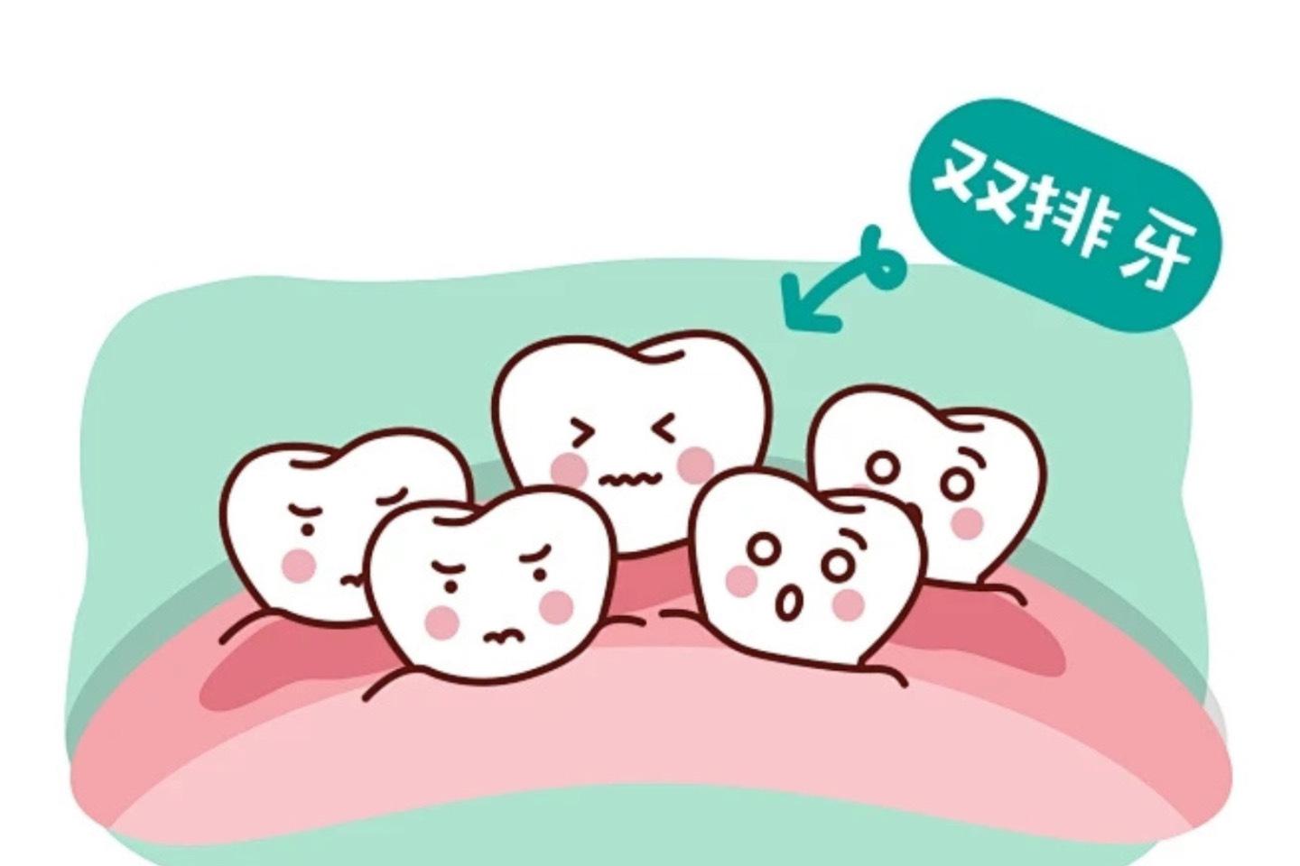 双排牙"问题:家长必读 你的宝贝是否在换牙期出现了双层牙齿的情况?