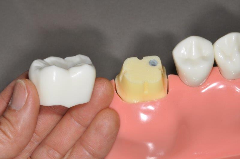 图源:dental crowns 