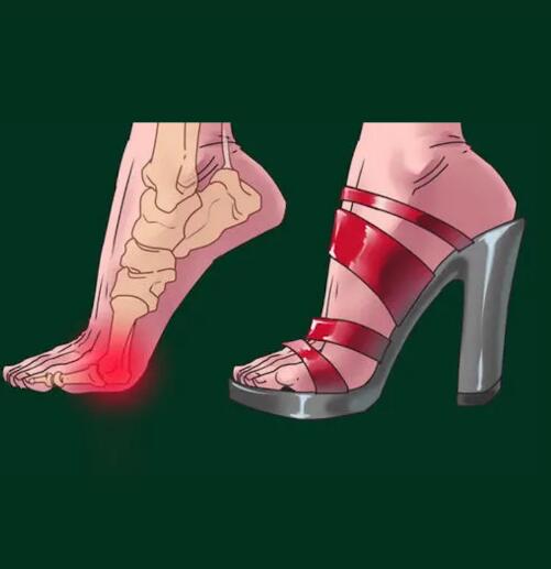 穿高跟鞋要注意，这些症状可能因为脚“肿瘤”！