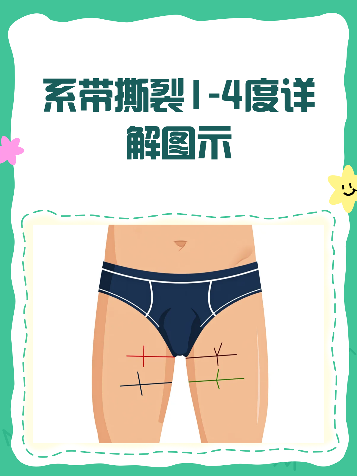 系带撕裂分度图解,一看就懂!